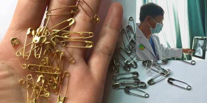 Sốt nhưng không khỏi, bé 10 tháng tuổi bị phát hiện hóc thứ 
