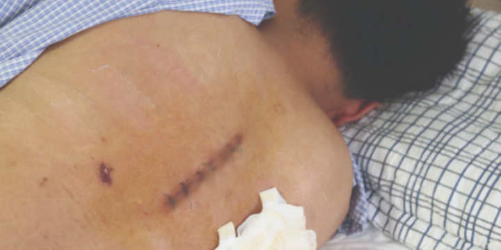 Tê mỏi 2 chân, thanh niên 19 tuổi bỗng liệt đi lại vì