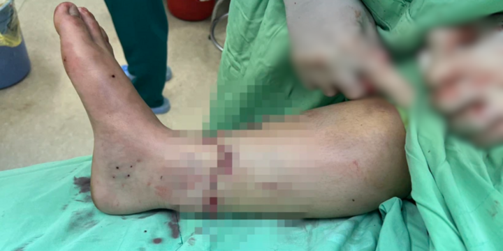 Nữ bệnh nhân được nối liền đoạn chân sau tai nạn giao thông