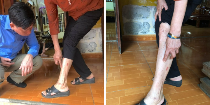 Thanh Hóa: Xác minh nguyên nhân khiến hàng chục người cùng 1 xóm mẩn đỏ toàn thân