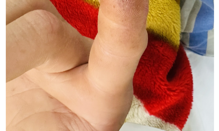 Xước đầu ngón tay, người đàn ông bị sốc phản vệ độ 2 vì loài vật hiếm