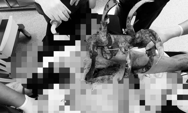 Người đàn ông cày ruộng không may bị lưỡi cày cắm sâu vào ngực, nách