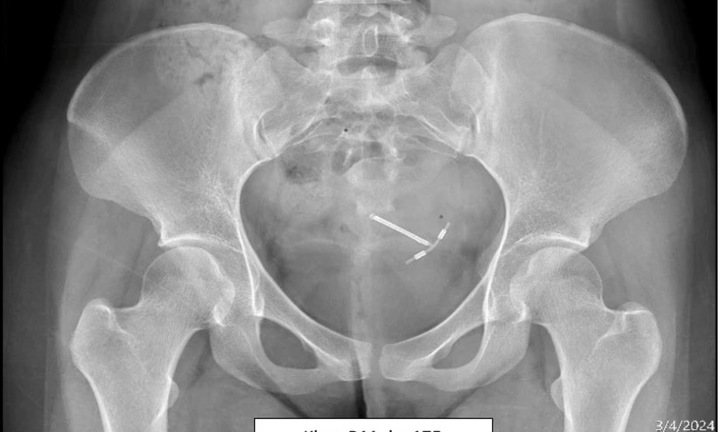 Vòng tránh thai “đi lạc” trong bụng nhiều năm mà không biết