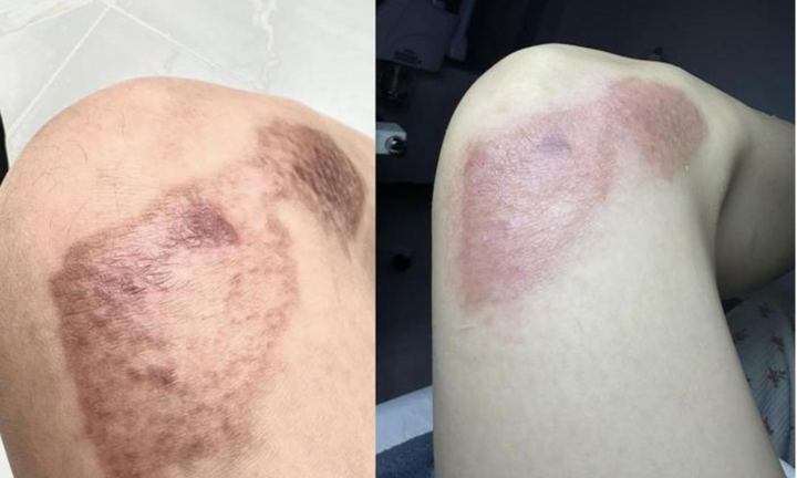 Ngọc Trinh điều trị những vết tích do tai nạn mô tô để lại