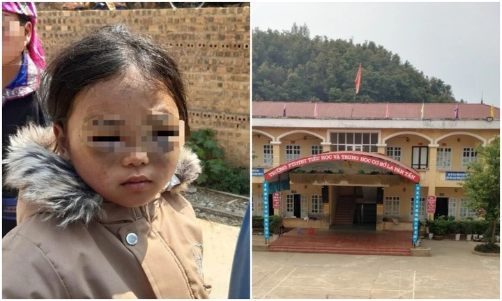 Báo cáo cụ thể vụ cô giáo bị tố đánh bé gái lớp 1 thâm tím 2 mắt