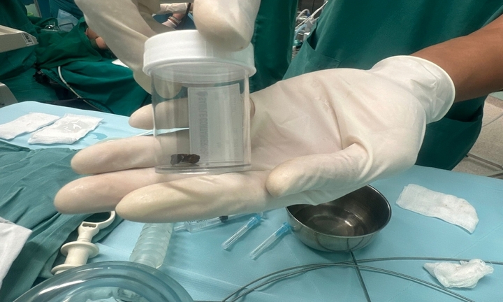 Hai bệnh viện phối hợp lấy dị vật trong đường thở cho bé 8 tháng tuổi