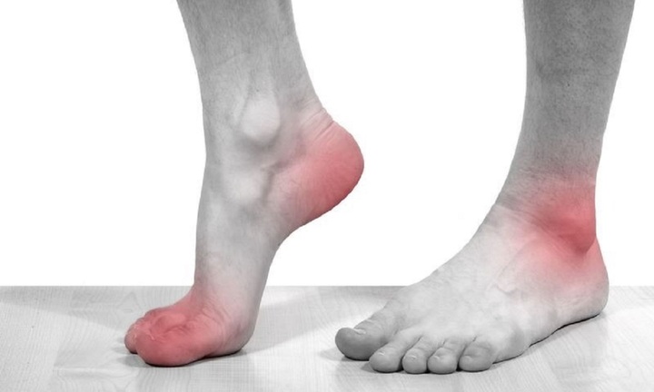 Những cách phòng ngừa bệnh gout hiệu quả, có thể bạn chưa biết
