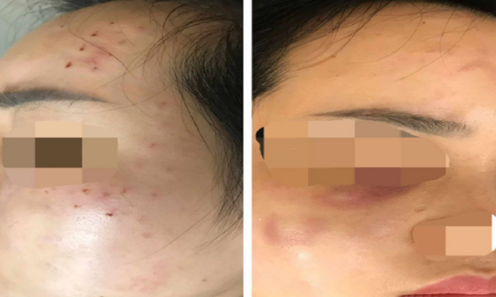 Đi tiêm meso, cô gái bị chủ spa tiêm nhầm sữa rửa mặt vào da