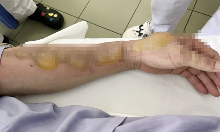 Đổ xăng đốt rác, hai người đàn ông bị bỏng nặng