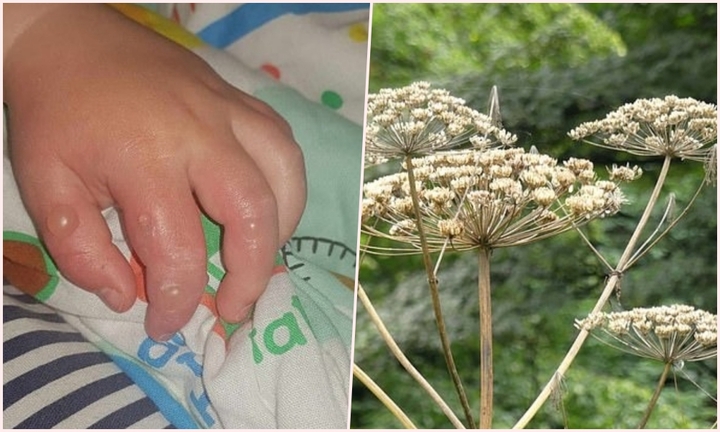 Loài cây nguy hiểm nhất nước Anh khiến bé trai bị phồng rộp khắp mặt và tay