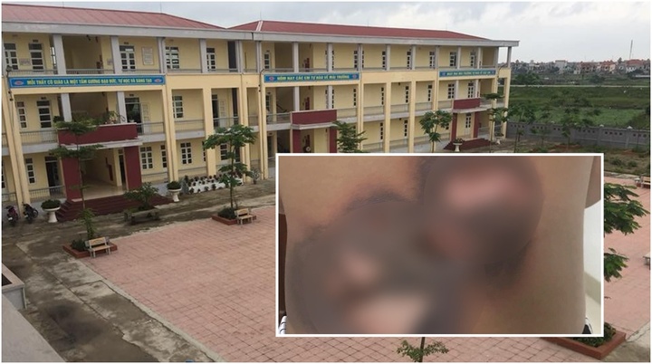 Chơi trò giác hơi bằng khí ga bật lửa, nam sinh lớp 9 bị bạn làm bỏng lưng