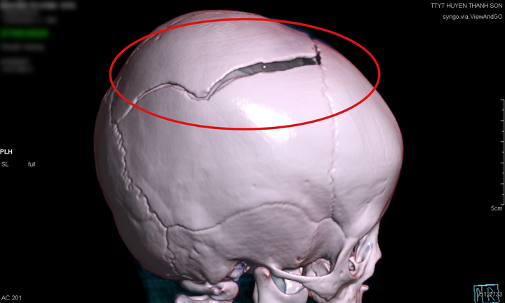 Sập cánh cổng nhà, bé gái 15 tháng tuổi bị chấn thương sọ não