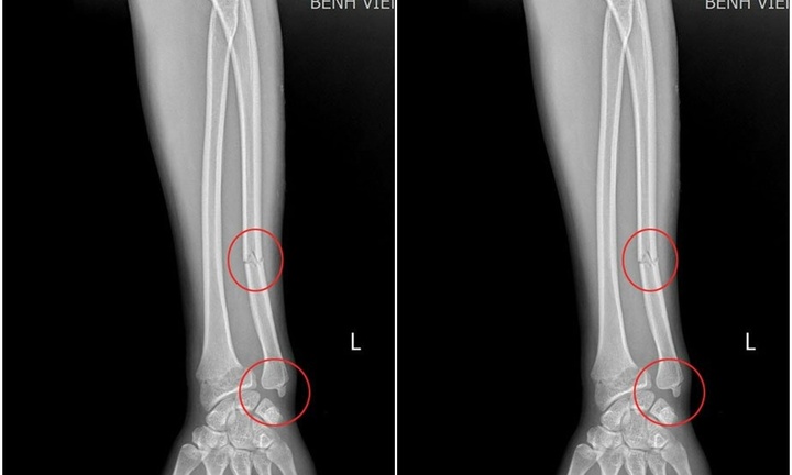 Cô gái 28 tuổi chấn thương nặng vì thứ quen thuộc của chị em ngày hè