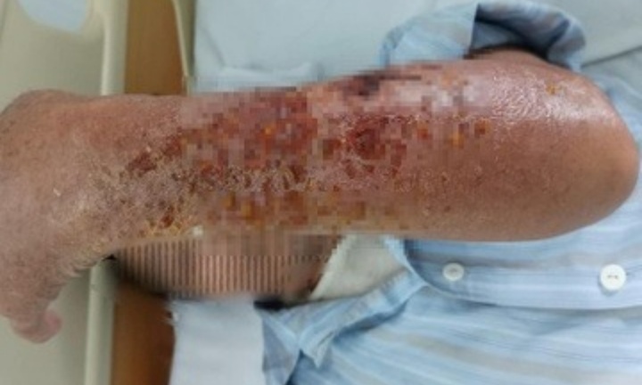 Tay người đàn ông lở loét do tự ý bôi thuốc vào vết thương mèo cào