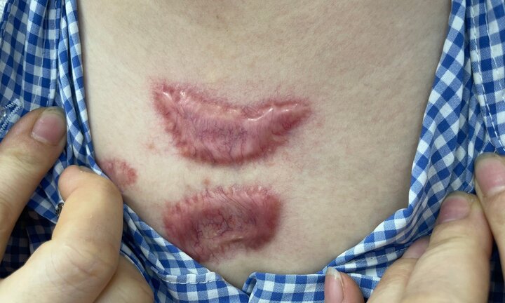 Tin quảng cáo “điều trị sẹo lồi 1 lần” người phụ nữ gặp biến chứng nặng nề