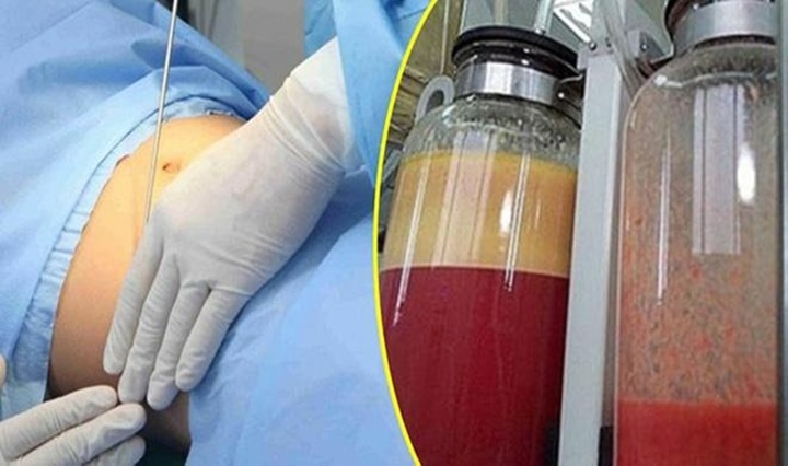 Sau phẫu thuật thẩm mỹ hút giảm mỡ bụng, người phụ nữ nhập viện Chợ Rẫy