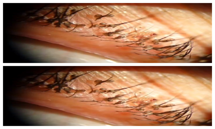 Rận mu đẻ trứng chi chít trên mi mắt người ở Hà Nội, xem thôi cũng nổi da gà