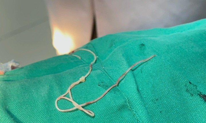 Giun rồng dài 30cm bò lúc nhúc dưới da, nguyên nhân vì món nhiều người mê