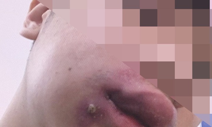 Tự cậy, nặn mụn mủ, nam thanh niên phải nhập viện cấp cứu