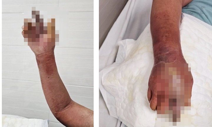 Tai nạn trong nhà khiến người đàn ông phải nhập viện cấp cứu