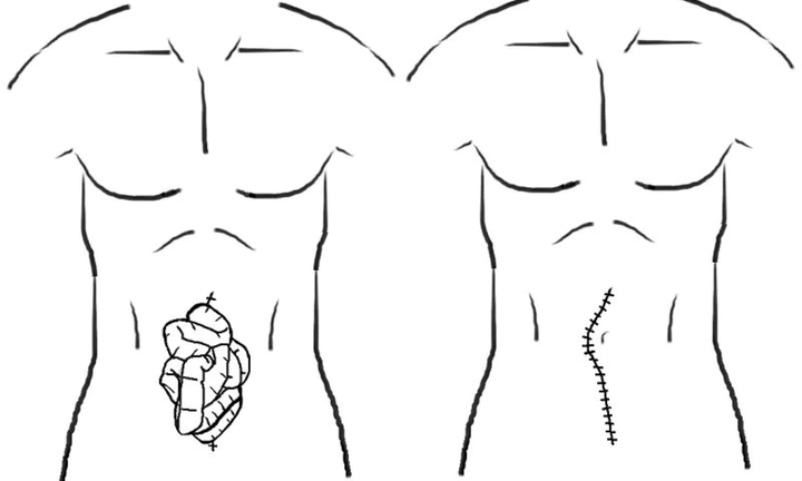 Oái oăm chuyện người đàn ông phải đi cấp cứu sau khi hắt hơi mạnh