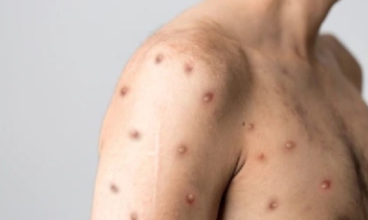 WHO cân nhắc tuyên bố tình trạng khẩn cấp toàn cầu đối với bệnh đậu mùa khỉ