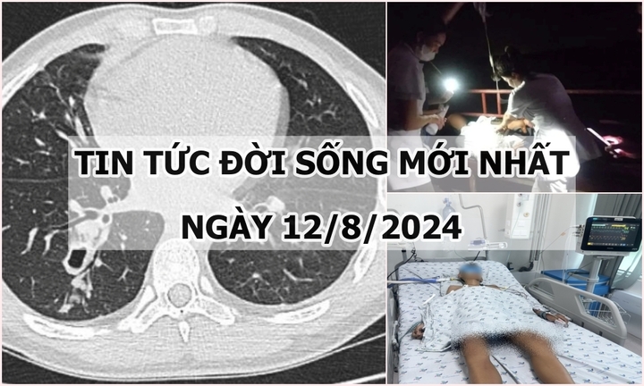 Tin tức đời sống ngày 12/8/2024: Bị ho ra máu, đi khám phát hiện nhiễm sán lá phổi