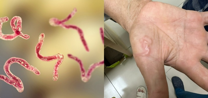 Người phụ nữ bị giun làm tổ trong cơ thể, vì nuôi con vật này