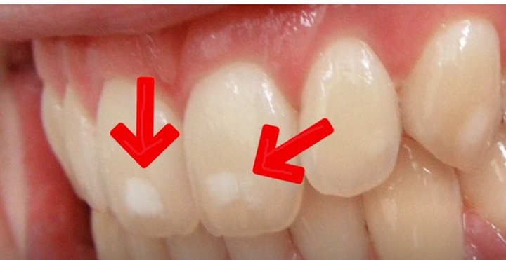 Vì sao răng có đốm trắng?