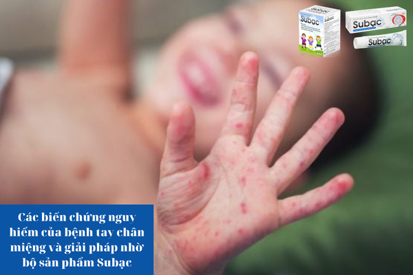 Các biến chứng nguy hiểm của bệnh tay chân miệng và giải pháp nhờ bộ sản phẩm Subạc