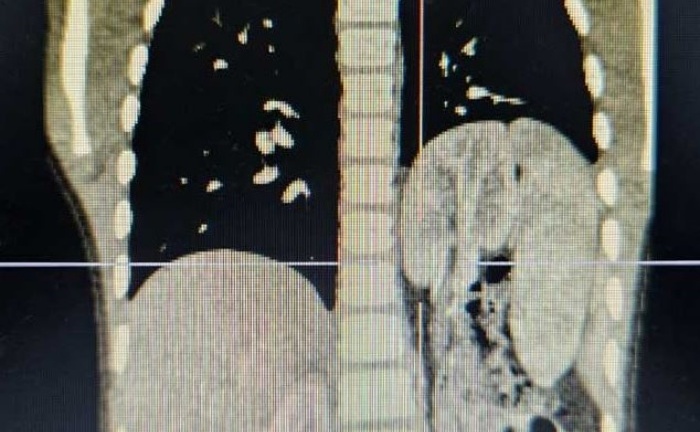 Phẫu thuật thành công cho bé trai 6 tuổi có thận lạc 