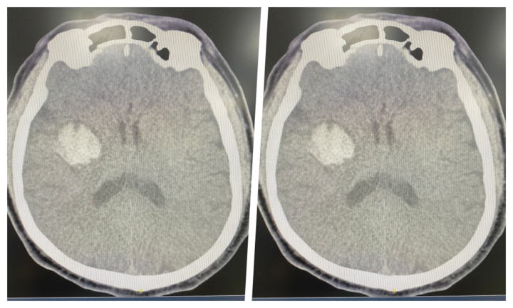 Nhập viện cấp cứu vì tự uống An cung ngưu hoàng hoàn: Người nhà tiết lộ bất ngờ