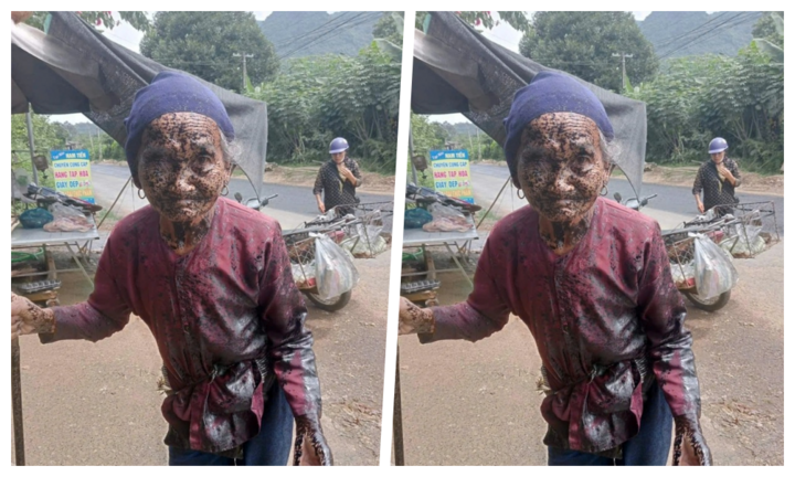 Thương cụ bà bị phun nhũ tương nhựa đường khắp người, nhìn ảnh thôi mà 