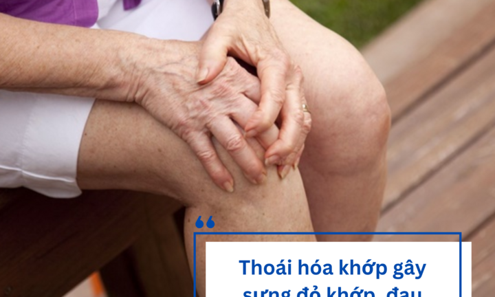 Các triệu chứng cảnh báo thoái hóa khớp và giải pháp từ CốtWells chứa màng vỏ trứng