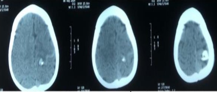 Thanh ray cửa lùa bất ngờ rơi trúng đầu, bé trai 29 tháng tuổi nhập viện cấp cứu