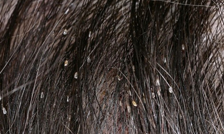 2 mẹ con cùng vào viện vì trị chấy bằng rượu ngâm loại hạt chứa độc tố này