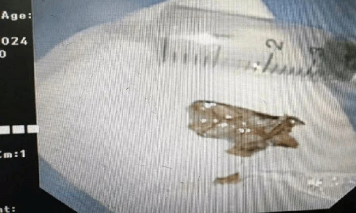 Hơi thở có mùi khó chịu suốt nhiều ngày, đi khám phát hiện bí mật rùng mình