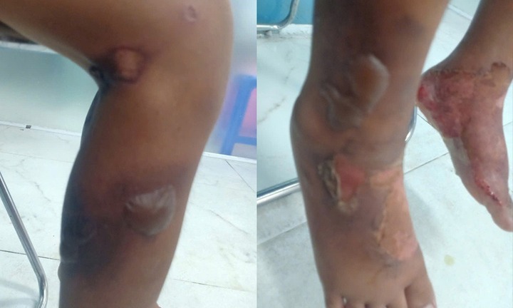 Diễn biến mới nhất vụ bé trai 6 tuổi nghi bị bạo hành, cơ thể bỏng rộp ở TP.HCM