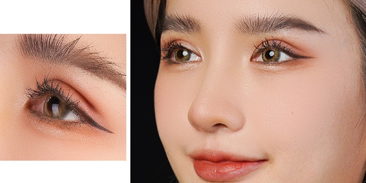 Có nên cắt mắt 2 mí không?