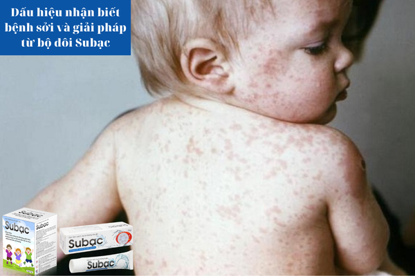 Dấu hiệu nhận biết bệnh sởi và giải pháp nhờ bộ sản phẩm Subạc