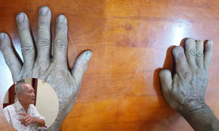 Vụ thảm án 6 người bên bờ biển Quảng Ngãi (Kỳ 4): Bàn tay cụt nhiều ngón 