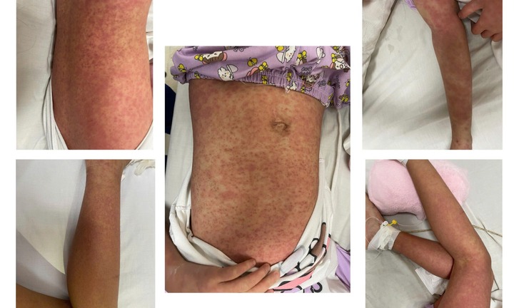 Căn bệnh lạ khó phát hiện khiến bé gái 10 tuổi nổi ban khắp người