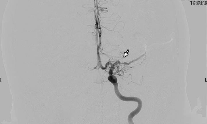Chàng trai 25 tuổi đột quỵ vì thói quen nhiều người Việt mắc phải
