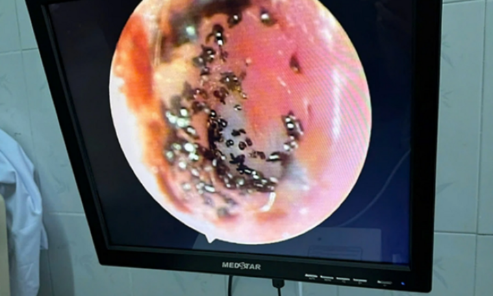 Bầy ve rận ký sinh bên trong tai bé gái 6 tuổi ở Quảng Trị