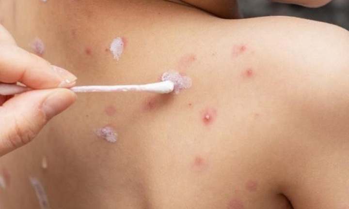 Phát hiện ổ bệnh thủy đậu tại một trường học ở Bến Tre