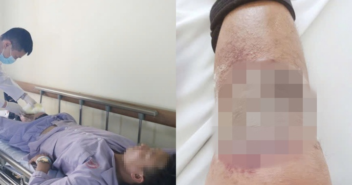 Bôi dầu nóng chữa gãy chân, người đàn ông nhiễm trùng da nặng