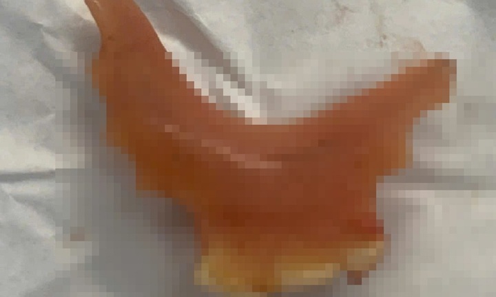 Người đàn ông 51 tuổi nhập viện cấp cứu vì sự cố hi hữu khi ăn