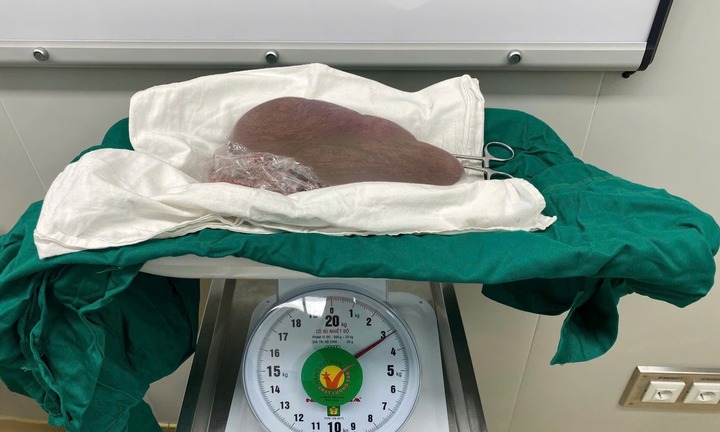 Bóc khối u nặng 3,2 kg trong người nữ điều dưỡng 23 tuổi