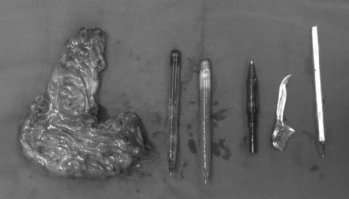 Người đàn ông 50 tuổi phải phẫu thuật cấp cứu do thói quen