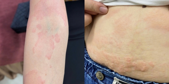  Người đàn ông ngứa khắp người sau màn nhậu ba ba tiệc tất niên